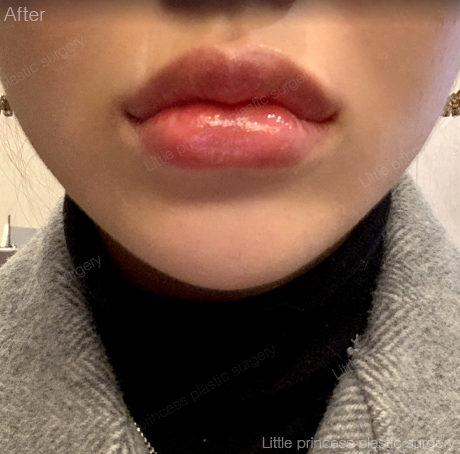 lpps_jp's tweet photo. 当院のサービスと院長の施術にご満足いただき、ありがとうございます。
また次回お会いいたします。

オリニコンジュ美容整形外科💖

LINE相談=@793jjgaa

#オリンコンジュ整形外科 #唇フィラー #リップフィラー #渡韓 #韓国整形 #口角ボトックス #フィラー #唇ヒアルロン酸 #唇ヒアル #ヒアルロン酸 https://t.co/xsgoFSOOgw
