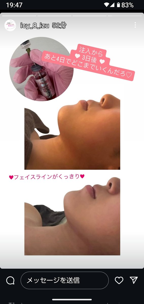 O5n1qKtAyzOwdci's tweet photo. GW明け、ちょっとゆるんできたかも…と思った方へ

ひよこ治療院では、
引き締めケアのご相談を承っています

◆ RED SHOT
お腹まわり、脚、二の腕など
気になる部分をポイントケア

無理のないペースや回数も
ご相談しながら進めていきますので、
そろそろ夏に向けて整えたい方はぜひご相談ください https://t.co/lnsPPXX6eE