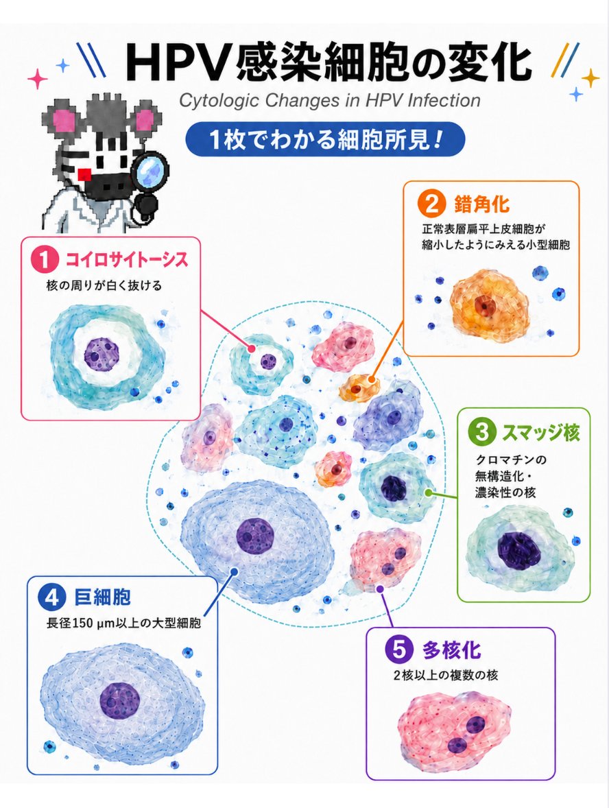 1枚でわかる！ 【HPV感染細胞の変化】 1：コイロサイトーシス 2