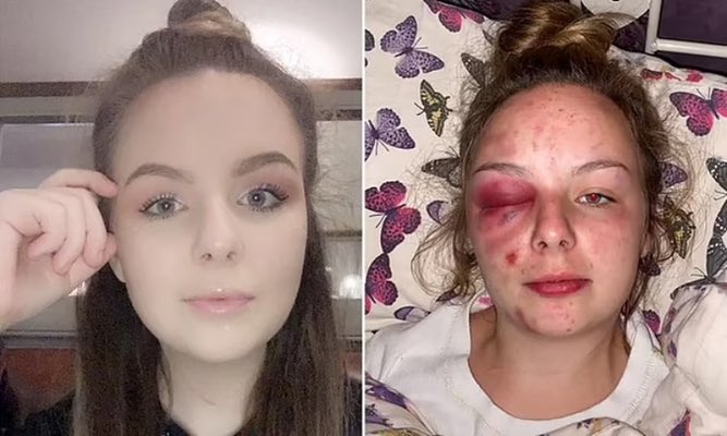 Ambar_SIFF_MRA's tweet photo. >Eleanor Williams
>From Barrow-in-Furness, Cumbria, England
>In 2020, falsely claimed she was brutally gang-r*ped and trafficked by multiple men
>Posted graphic photos of her self-inflicted bruises and injuries on Facebook
>Sparked massive public outrage and months-long police investigation
>Innocent men had their lives destroyed, several attempted suicide
>Finally she was convicted of multiple counts of perverting the course of justice
>Sentenced to 8½ years in prison in 2023
Only 8.5 years in prison for destroying the lives of so many innocent men.
Never believe women, only believe evidence and wait for complete investigation. False accusations are second nature to them.