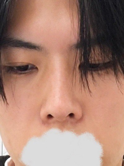 DDk89670's tweet photo. ミジャク美容外科:術後5ヶ月後

術後5ヶ月が経過しました。前回と比べて変化は感じられませんが安定しています。仕上がりも自然です。なお、肋軟骨を採取した部位の傷はまだうっすら残っています。
@mijak_jp https://t.co/dKWPYif5j9