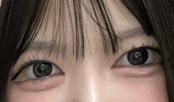 l99811O7's tweet photo. ザビビさんで目��タレ目再手術したdt3ヶ月のときの写真です！💕
希望した通りナチュラルな仕上がりです🩶
#ザビビ整形外科 https://t.co/PHApF5aPgS