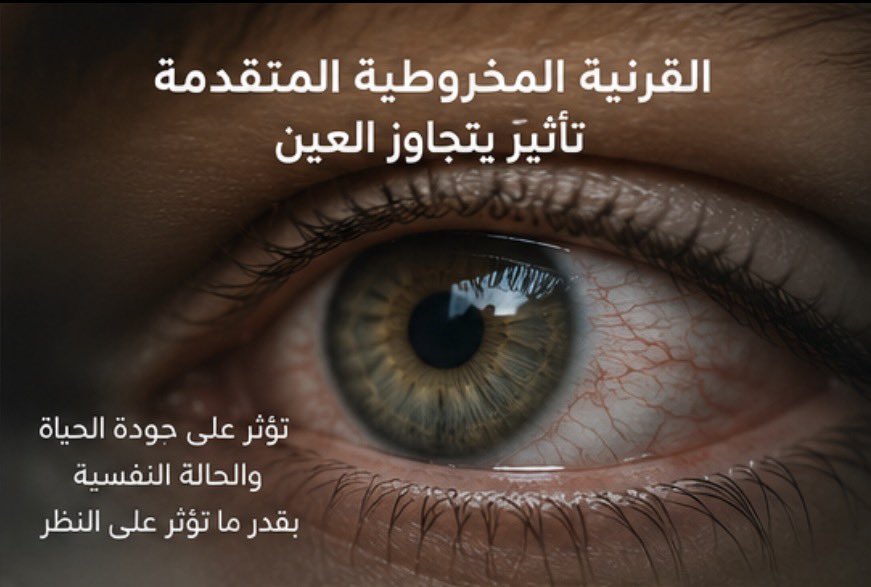 ntoosh's tweet photo. هل تؤثر مشاكل الإبصار و #القرنية_المخروطية  على الشخصية فعلًا ؟! 

تابع #السرد 

1️⃣
من واقع التعامل اليومي مع مرضى القرنية المخروطية وضعف الإبصار، نلاحظ أحيانًا أن المشكلة لا تكون بصرية فقط…
بل تنعكس أيضًا على الشخصية وطريقة التفاعل مع الحياة والناس.. https://t.co/wkYoJwsu4W