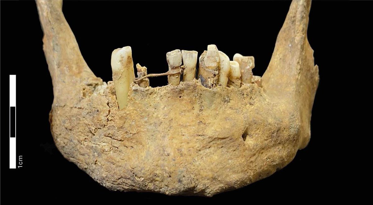 The_BDJ's tweet photo. Would you trust your smile to a jeweller in the 1500s? 👀🦷

Scotland’s earliest known restorative dentistry: a gold ligature bridge on lower incisors from Aberdeen (1460–1670 CE), likely placed by a semi‑skilled practitioner. ⚒️✨

Explore here 👉 https://t.co/ruJTBDHy0o https://t.co/bhXbAR0w0p