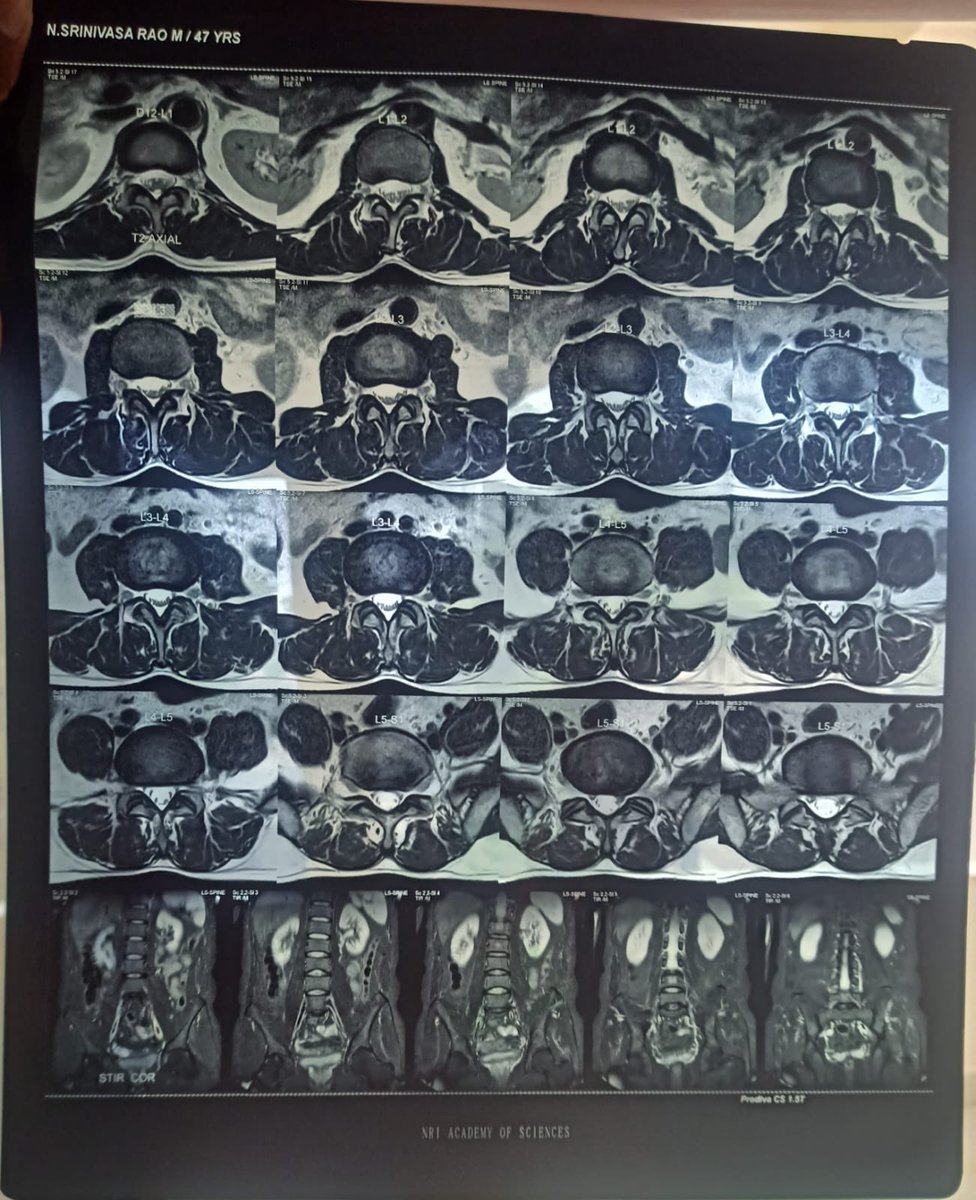 Kalyan_Trends9's tweet photo. Urgent help needed 🙏

My friend’s father has been diagnosed with severe lumbar spine disc disease (L4-L5 / L5-S1) and doctors have advised immediate surgery tomorrow due to unbearable back pain and difficult even for sitting or standing. https://t.co/egueZeg7e8
