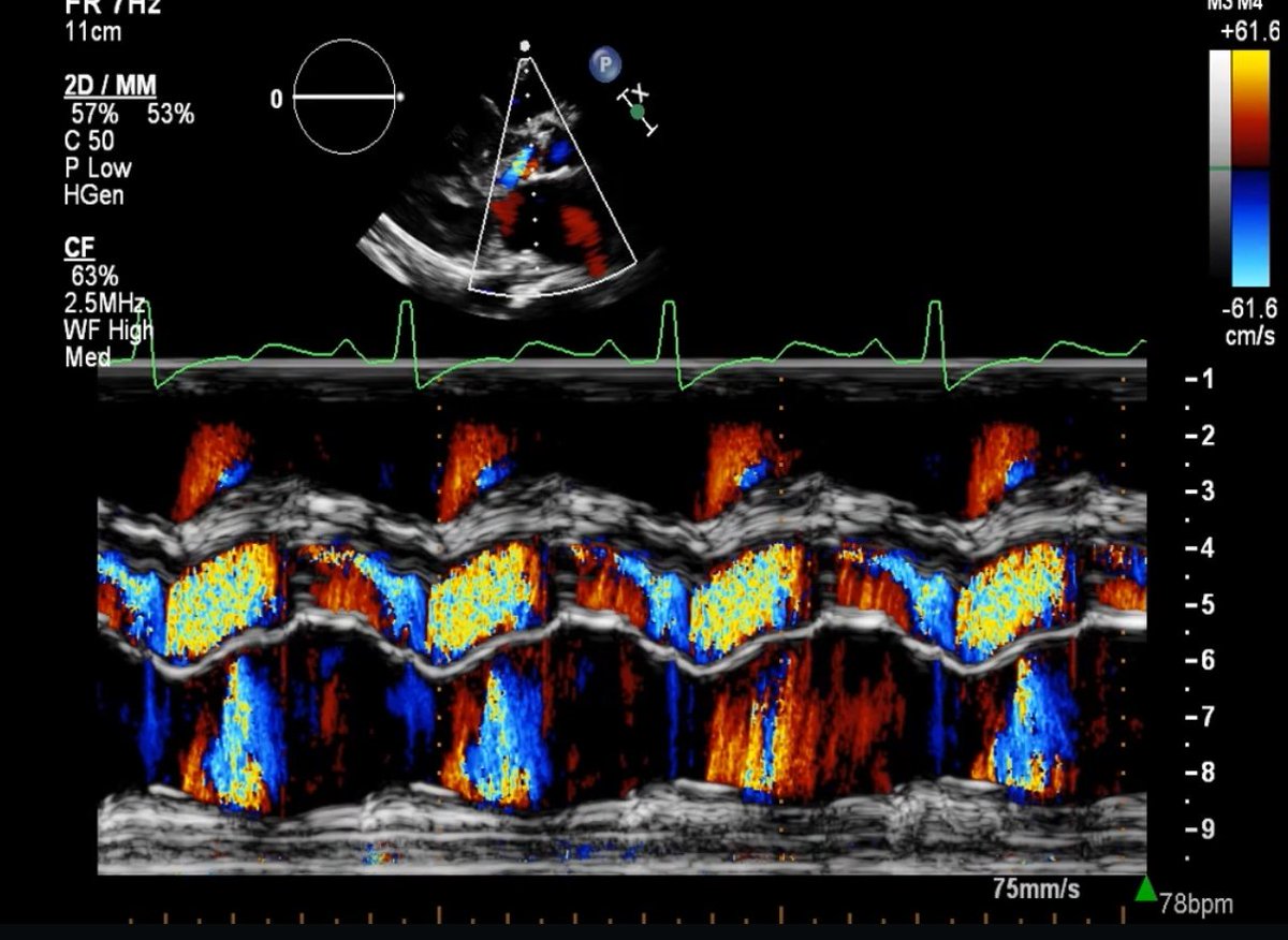 drahmedmohsen85's tweet image. 🫀🎨 Color M-Mode PLAX over AV

At first glance 👀 looks like severe AR 🌊
But ECG timing is the key 🔑

✅ Main turbulence = SYSTOLIC → subaortic/LVOT obstruction
✅ Small diastolic jet = mild eccentric AR

AV opens well 🚪➡️ favors subaortic obstruction over valvular AS 🔥