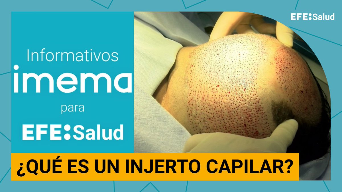 efesalud's tweet photo. ⁉️¿En qué consiste un injerto capilar? 

📺 Informativo @Clinica_Imema con el Dr. Eduardo López Bran, dermatólogo experto en microcirugía aplicada al trasplante capilar. 

👉 "Después de la extracción de miles de folículos pilosos de la nuca del paciente o zona donante, cada bulbo piloso se redistribuye de manera natural en la zona receptora ó area calva", explica el Dr. Eduardo López Bran.

📲 https://t.co/hP6qAh4Yl0