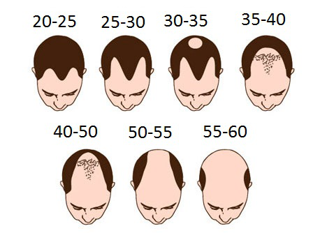 เห็นเพื่อนหลายๆคนเริ่มผมบางแร้ว 26-27 เอง น่ากลัวมากๆชีวิตคนเราแก่เร็วจริง