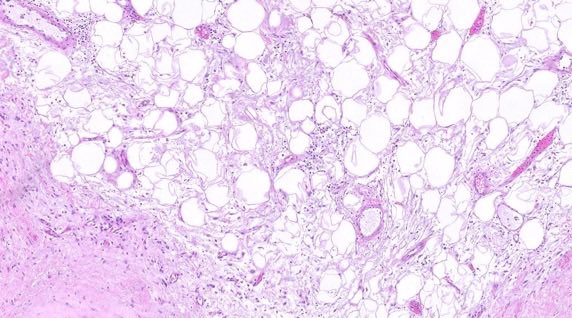 katcollmd's tweet photo. #slidearchiveseries perinephric myxoid pseudotumor of fat #gupath #pathtwitter #pathoutpic

🔬 fat with lymphoplasmacytic infiltrate and myxoid change
📍non-neoplastic renal disease and transplant
⚠️ mimics WDLPS and IgG4-related sclerosing disease

🔗 https://t.co/0P5xiAh0bu https://t.co/RQE96OUOpM