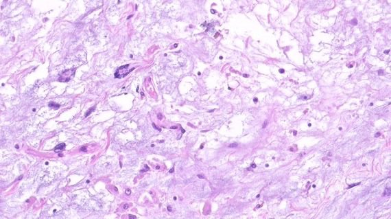 katcollmd's tweet photo. #slidearchiveseries perinephric myxoid pseudotumor of fat #gupath #pathtwitter #pathoutpic

🔬 fat with lymphoplasmacytic infiltrate and myxoid change
📍non-neoplastic renal disease and transplant
⚠️ mimics WDLPS and IgG4-related sclerosing disease

🔗 https://t.co/0P5xiAh0bu https://t.co/RQE96OUOpM
