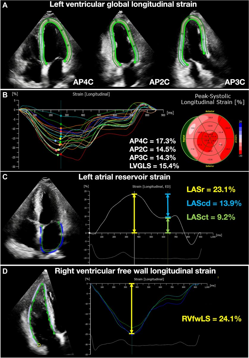 JACCJournals's tweet photo. 💓 Left atrial reservoir strain (LASr) predicts heart events better than LV or RV strain. 🩺 Routine LASr measurement may improve risk assessment and patient care 📊 https://t.co/x1DwWY3mgp

#JACCAsia @pi_the_anion https://t.co/btJPlakYk3