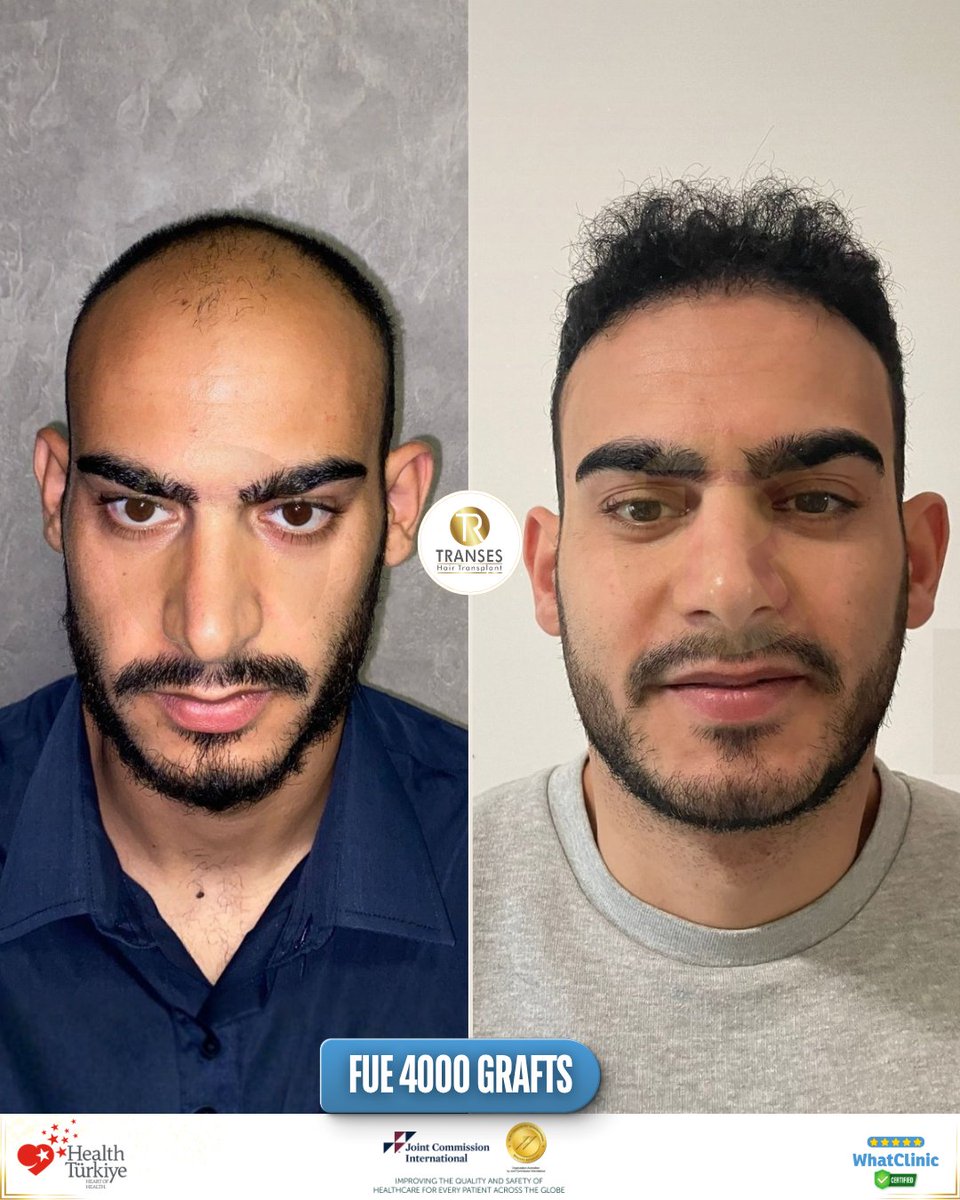 transeshair's tweet photo. This hair transplant operation was performed at Istanbul Tema Hospital BHT Clinic.
15 years of experience with a 4.9 ⭐ WhatClinic rating.
FUE • DHI • HYBRID • PRP
Natural results, professional care.

#YourJourneyYourTransformation
#TransesHairTransplant
#FUE #DHI #PRP https://t.co/WVp0AfFzXk