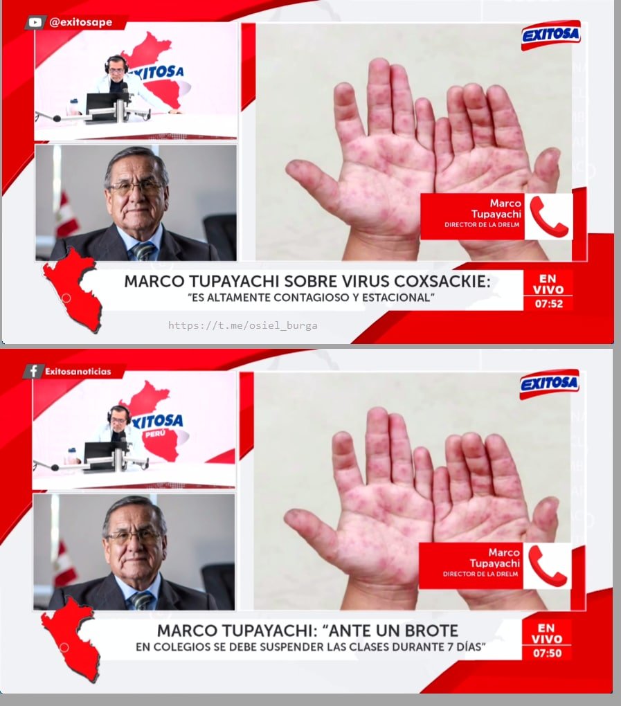 OsielBurga's tweet photo. El virus COXSAKIE en ESCENA: Lo que callan los medios, funcionarios y documentos secretos de vacuna COVID-19 de Pfizer

> De repente “brote estacional”… justo cuando los documentos secretos de Pfizer lo tenían anotado desde hace años. @exitosape @IroChaguaPayano https://t.co/G7G8cyzJ5x