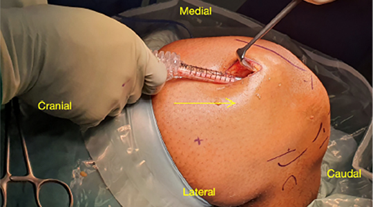 PC_Orthopedics's tweet photo. The Rectus Femoris Graft: Expanding Your Options in ACL Reconstruction 🚀
Looking for a robust alternative to hamstrings for complex cases? 
Explore the concept ➡️ https://t.co/tgSRO2bFjd https://t.co/fbCAczXoPw