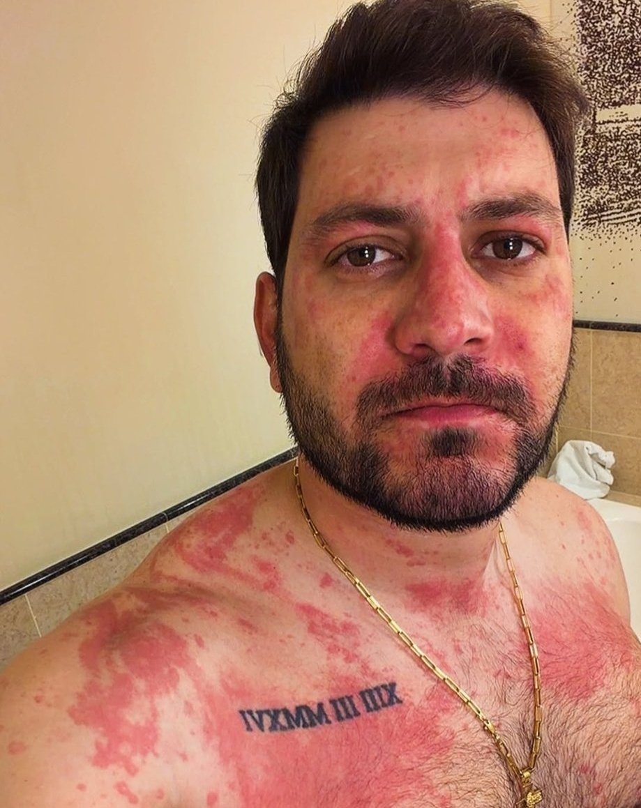 sitepopmais's tweet photo. Ex-BBB Caio Afiune é hospitalizado após reação alérgica. https://t.co/e1FUiaB7Dp