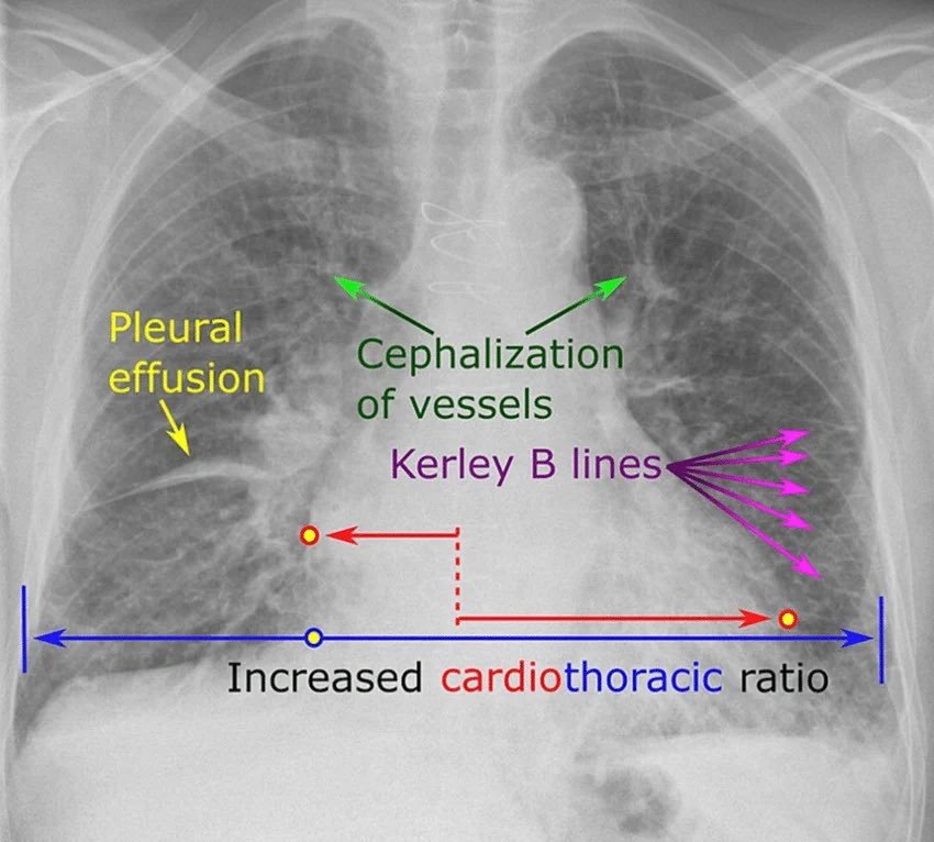 DrAyubaD's tweet photo. Beautiful illustration of the findings in a patient with congestive cardiac failure .

Findings 
1. Cardiomegaly 
2. Cephalization or upper lobe diversion
3. Fluid in fissures ( labeled here as effusion)
4. Kerley lines 

Enjoy ! https://t.co/bIRu1ClHCC