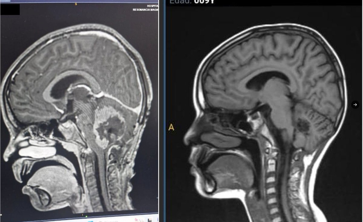 🚨 9-YEAR-OLD BOY’S BRAIN CANCER COMPLETELY CURED!

Dr. William Makis reports an absolute MIRACLE:A 9-year-old boy in Colombia with Medulloblastoma in the cerebellum has achieved total tumor clearance after just 3 months.

His family started Ivermectin + Mebendazole in November
