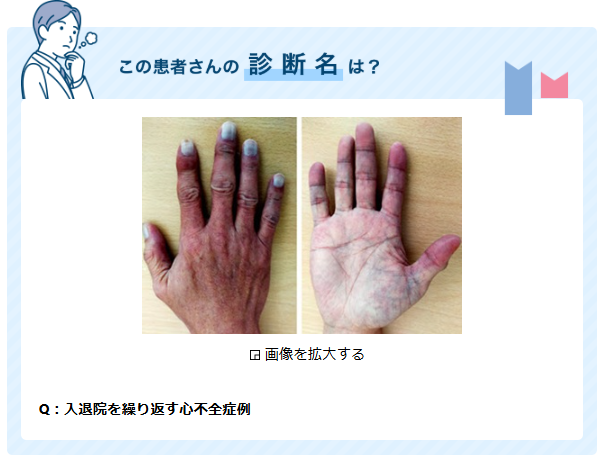 jsbtk's tweet photo. ＼CareNet 連載中／

🧐 心不全例では指先の冷感を確認

https://t.co/FypXN6SrLB https://t.co/3lOi3kXPOu