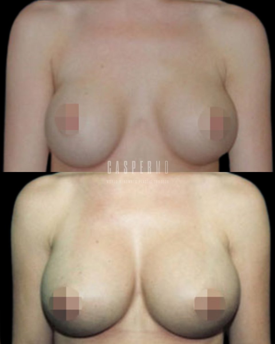 drdanielcasper's tweet photo. A second chance at getting it right.

This breast revision corrected prior implants to create a more balanced, natural-looking result that fits the patient’s frame beautifully. Subtle adjustments, big difference.

Thinking about a revision? Let’s talk: https://t.co/LPOpcWMaNc https://t.co/vtzNRGsAM5