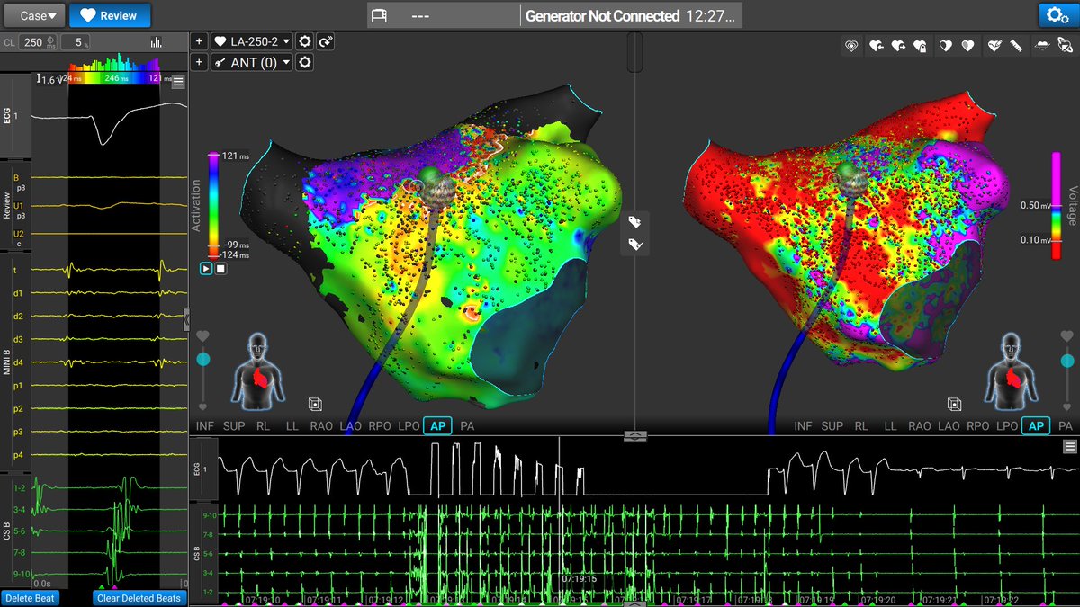 gennarofabiano's tweet photo. 3 cases. 3 rhythms restored. Affera in persistent AF and atypical flutters. ⚡️ #AtrialFibrillation #PersistentAF #AtypicalFlutter #Electrophysiology #CardiacAblation #SinusRhythm #Affera #Cardiology @IacopinoSaverio @GVMCareResearch @Medtronic https://t.co/NKECU1N1aj
