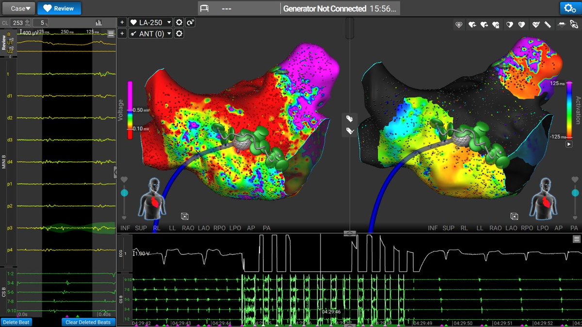gennarofabiano's tweet photo. 3 cases. 3 rhythms restored. Affera in persistent AF and atypical flutters. ⚡️ #AtrialFibrillation #PersistentAF #AtypicalFlutter #Electrophysiology #CardiacAblation #SinusRhythm #Affera #Cardiology @IacopinoSaverio @GVMCareResearch @Medtronic https://t.co/NKECU1N1aj