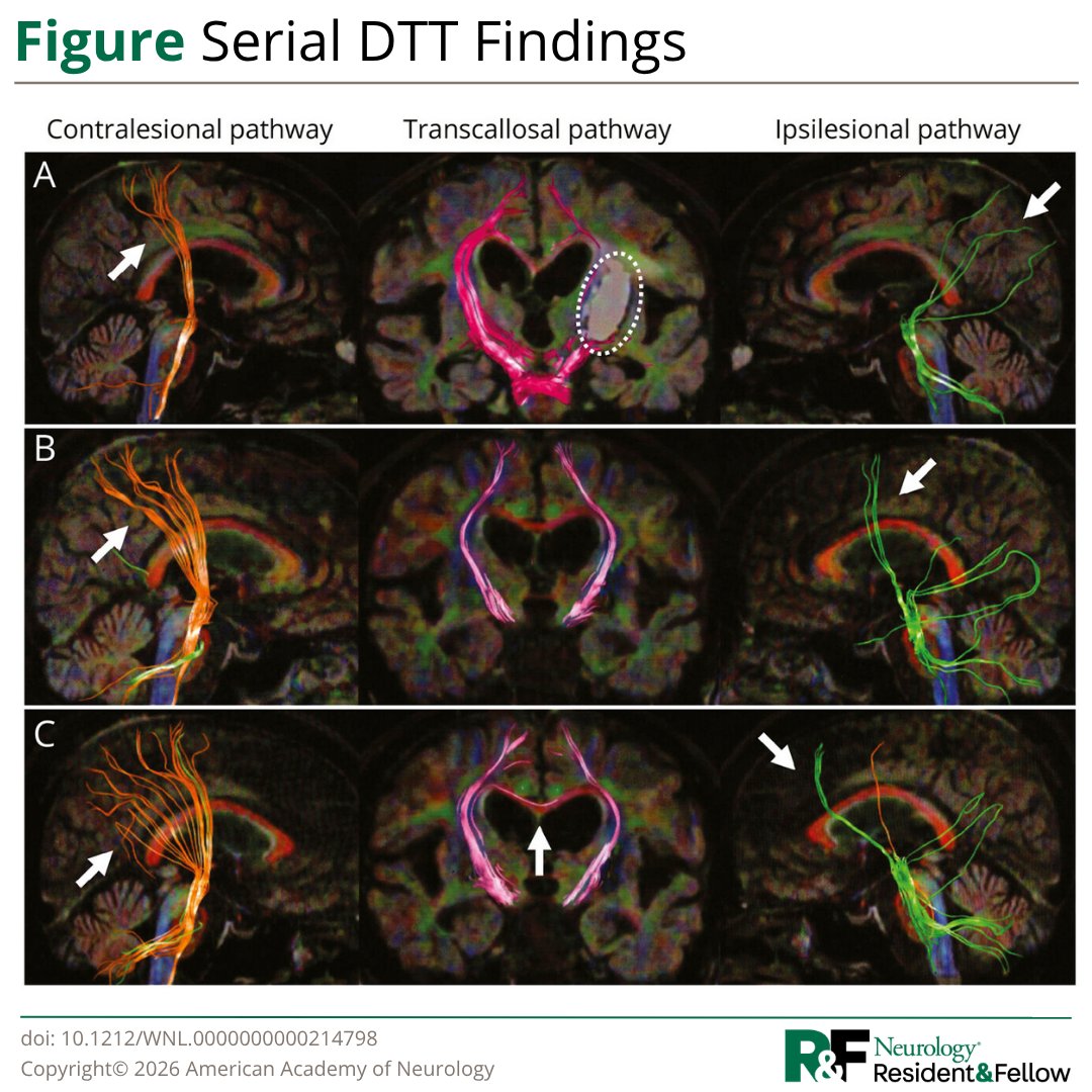 GreenJournal's tweet photo. Fire up those synapses for the latest #NeurologyRF quiz!

After hemorrhagic stroke, serial diffusion tensor tractography (DTT) showed a sequential anterior shift in ipsilesional motor pathway origins and dynamic changes in contralesional and transcallosal pathways. https://t.co/sFgfR2kBiB