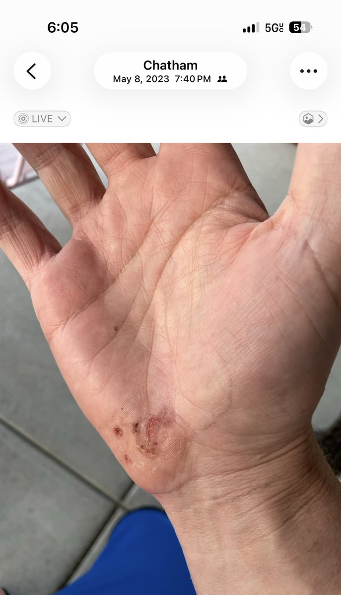 NFleer's tweet photo. Hey @Melaleuca this would be a good advertisement for you.  Only used @Melaleuca tea tree oil.  Pics 2.5 days apart. https://t.co/dM3Z2KrbfP