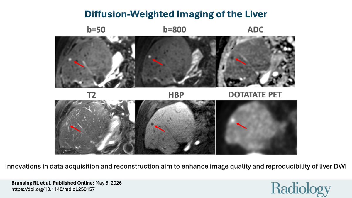 RadiologyEditor's tweet photo. 🧲 Liver MRI, close up.

Diffusion‑weighted imaging (DWI) detects microscopic water motion to flag cancer, characterize lesions, and act as a quantitative biomarker.

This review covers state‑of‑the‑art liver DWI, current challenges, and what’s next.
https://t.co/IcCpBQVjtv https://t.co/JmstQKcev9