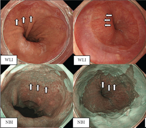 FrontGastro_BMJ's tweet photo. Upper GI endoscopy done well is more than reaching D2. 🔦📸

New BSG & AUGIS guidance in @FrontGastro_BMJ sets out best practice for upper GI endoscopy — from preparation and mucosal visualisation to lesion recognition, photo-documentation and quality standards. 🏥✅

Essential reading for anyone performing, training in or quality assuring OGD.

Read more: https://t.co/TSOGiNd1j2

#UpperGI #Endoscopy #OGD #QualityImprovement #Gastroenterology #FrontlineGastro #GItwitter #EndoscopyTraining #MedEd @gastroreg @BritSocGastro @my_UEG @AmCollegeGastro @DDWMeeting @ESGE_news @drkeithsiau @DrOmerAhmad @Dunnepdj @shraddha_gulati @CardiffGastro @DrBuHayee @poodocnisha @Sharm_Sub @PhilSmithIsBack @OTavabie @dr_aditi_kumar @TrevorTabone @eathar_s @IrenePerezMD @KGananandan @zare_benjamin @medicalreg @dtleiberman