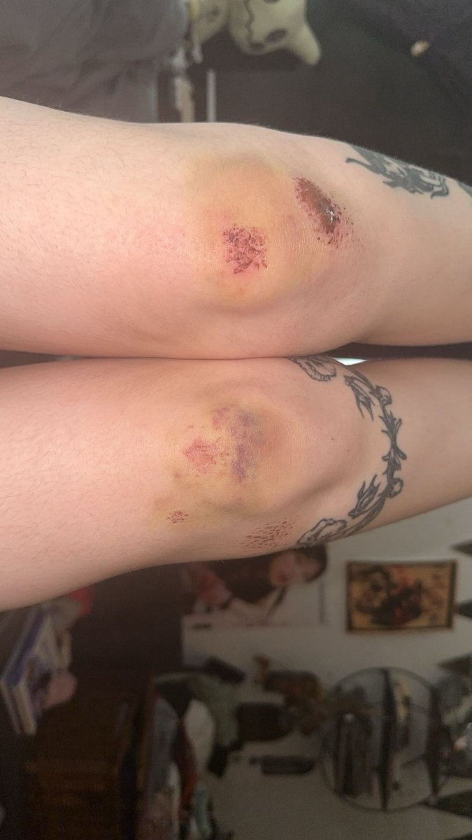 gutzindulgence's tweet photo. The day I learn stop drunk electric scootering with like 5 people on the back 😔#hopecore https://t.co/QpC44PCUci