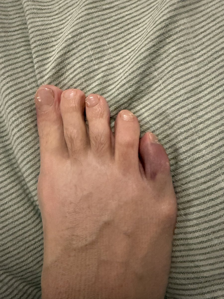 cr0nin's tweet photo. @RogueScholarMDC Maybe. Maybe not. I kicked my bed 12 hours before a flight to Mauritius and I’m fairly sure I broke my little toe. Strapped it up and sunk a few lagers and it no longer became an issue. Strap it and start drinking :) https://t.co/whKhiRrIbi