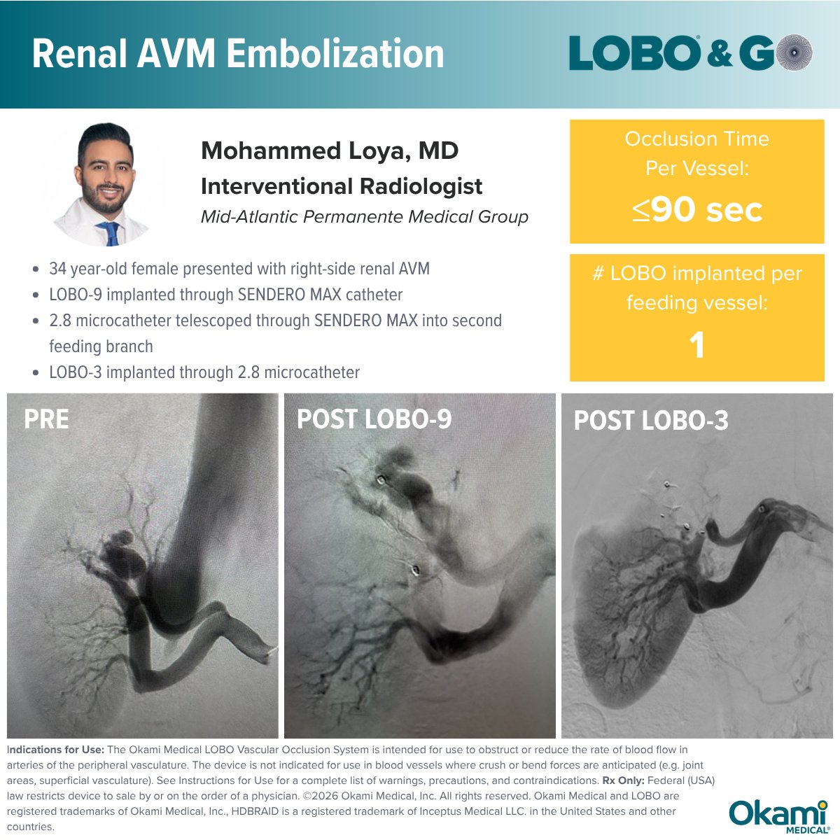 OkamiMedical's tweet photo. Rapid occlusion and a single device implanted per vessel.

Dr. Mohammed Loya recently achieved these results with LOBO for a renal AVM embolization.

#OkamiMedical #LOBO #Embolization #InterventionalRadiology #MedTech https://t.co/JEAb6o6qpV