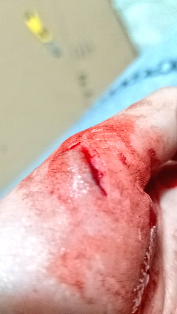 Gatito_miaus1's tweet photo. guys i got a happy accident, does this mean i hit sytros? Plus my arm is starting to feel numb can someone explain whyy #sh #shtwt #blood #sytro #cuts #veins https://t.co/FqAcpyHvx2