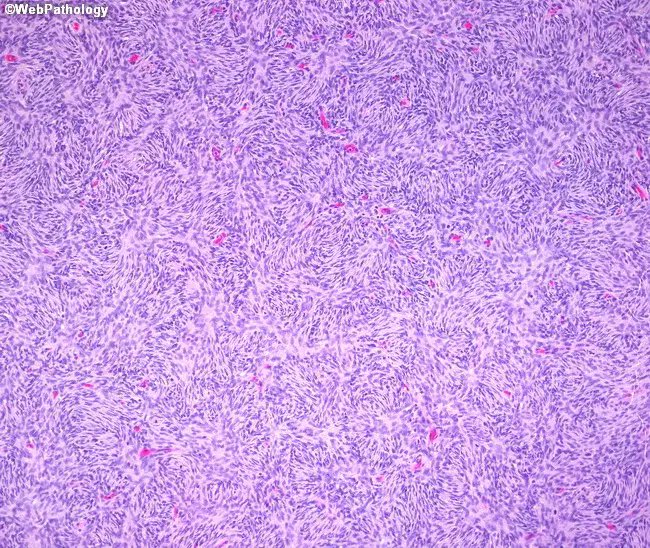 Manasi_Trivedi's tweet photo. DFSP
π· Thin walled vessels with infiterating margins
#softtissuepath
#bstpath https://t.co/2MsMyt8wAZ