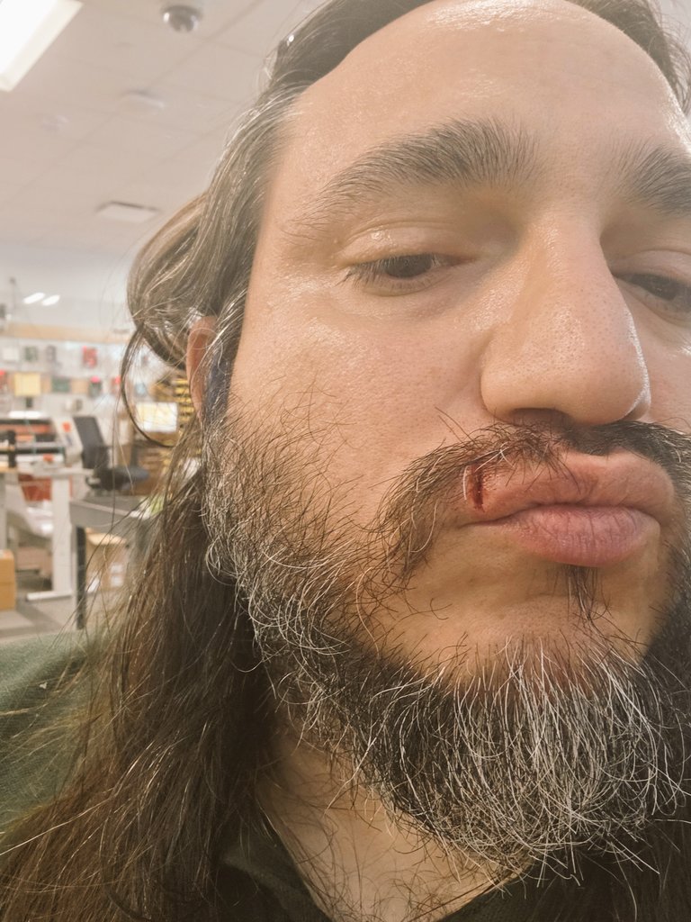 calmborders's tweet photo. @grangertattoos I busted my lip too! only 3 stitches though so not terrible. sorry we're busted lip buddies. https://t.co/DSBGGyMiI1