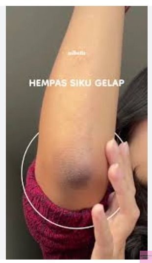 Yap! Guys izin bertanya, btw sikut tangan kiri ku hitam kaya gini. Ilangin pakai apa ya yang manjur?