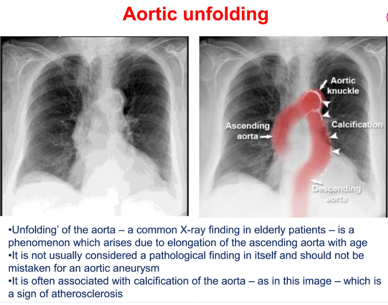 schowardjd's tweet photo. @drsthanus Aortic unfolding.

🩻 Widened superior mediastinum w/ a well-defined right paratracheal mediastinal bulge contiguous with the aortic arch. No focal air-space opacity, pleural effusion, or PTX. Cardiomediastinal silhouette is not enlarged. No acute osseous abnormality identified. https://t.co/WKi9VKcb6t