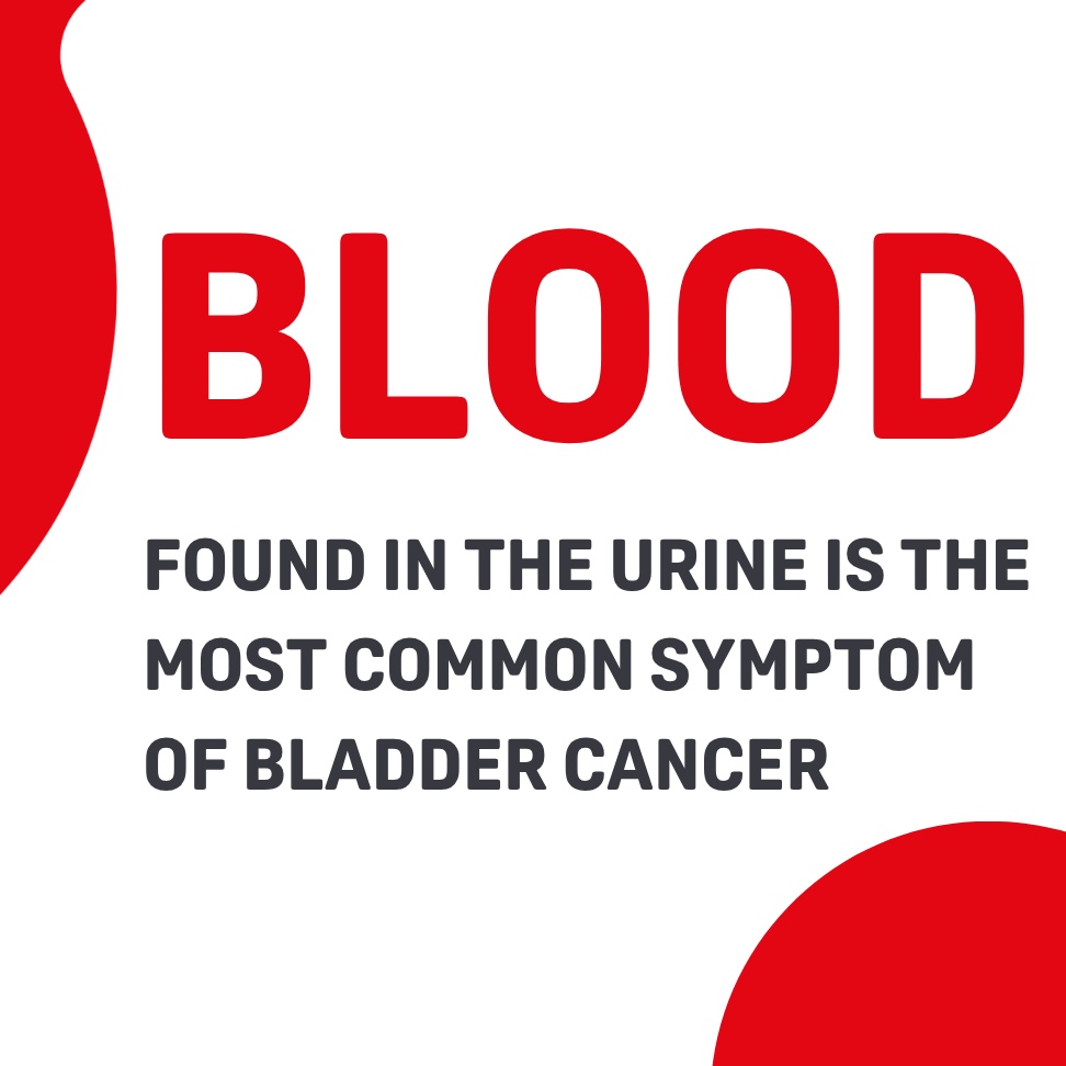 WorldBladderCan's tweet photo. 🚨 Blood in the urine is the most common symptom of bladder cancer.
Yet too many people ignore it or wait too long to seek help.
610,000+ people are diagnosed each year worldwide.
Blood in urine is never normal. Get checked.