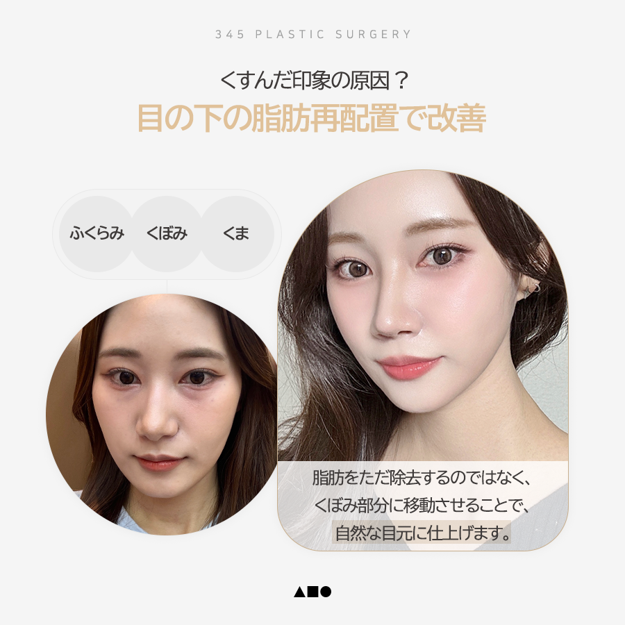 345plastic's tweet photo. 目の下だけで、印象はここまで変わる✨

クマ・たるみ・ふくらみで
疲れて見えていませんか？

345の「目の下の脂肪再配置」は
ただ脂肪を取り除くのではなく、
くぼみ部分へバランスよく移動させることで
自然で明るい目元へ導きます。

✔ クマで暗く見える方
✔ 目の下のたるみが気になる方
✔ 老けた印象を改善したい方

涙袋は残しながら、
凹凸だけを整えるナチュラルな仕上がりに✨

あなた本来の魅力を引き出す目元へ。

📍345 Plastic Surgery
ご予約・ご相談はプロフィールリンクから

#目の下の脂肪再配置 #クマ改善 #目元整形 #たるみ改善 #若返り #韓国美容外科 #韓国整形 #345美容外科 #345整形外科