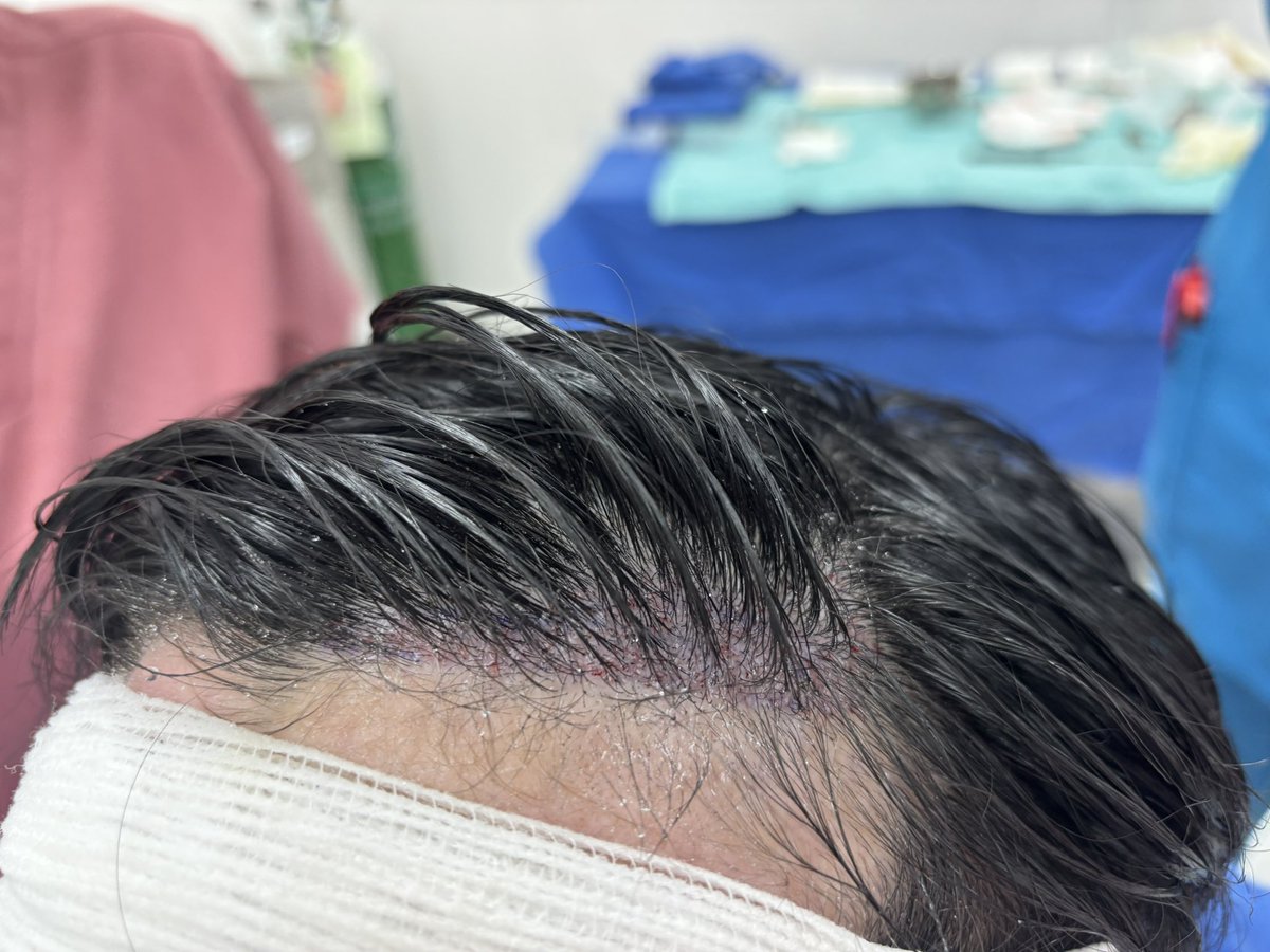 shokumo_journey's tweet photo. 【植毛手術直後】
5月1日に2回目の植毛手術をしてきました。
写真は術後直後の状態です。
今回は頭頂部830株・生え際左側296株を移植しています。 https://t.co/UuHSVwxWI3