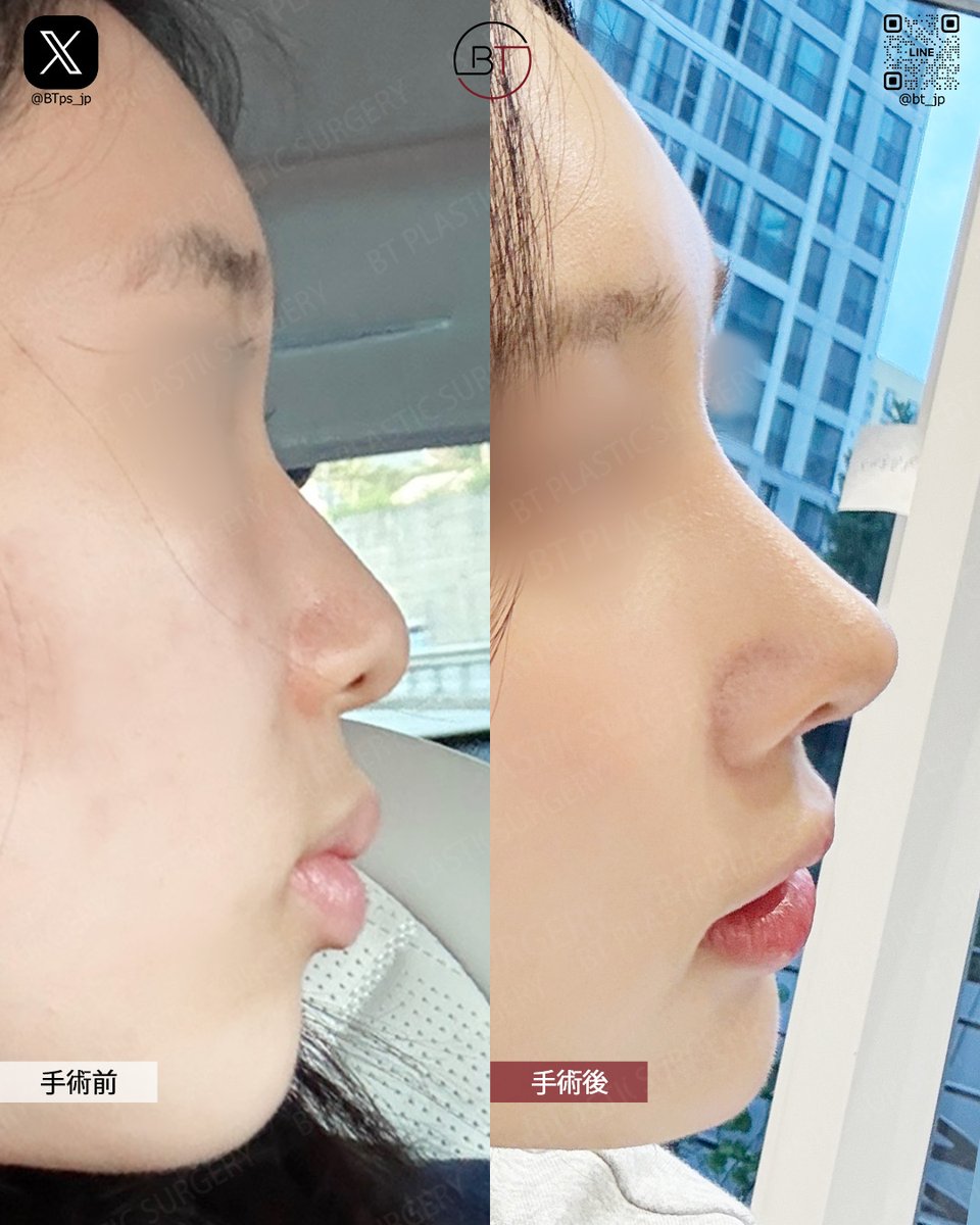 韓国BT整形外科「輪郭と鼻手術専門」 tweet media