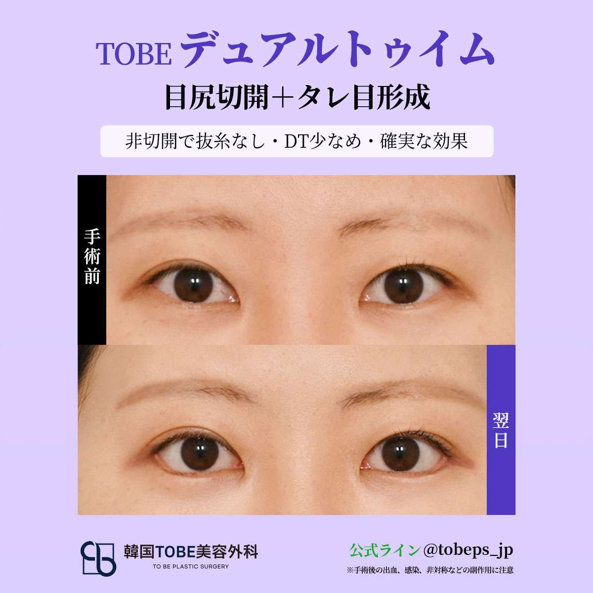 韓国TOBE美容外科 〚 二重・目元整形・目の下脂肪再配置〛 tweet media
