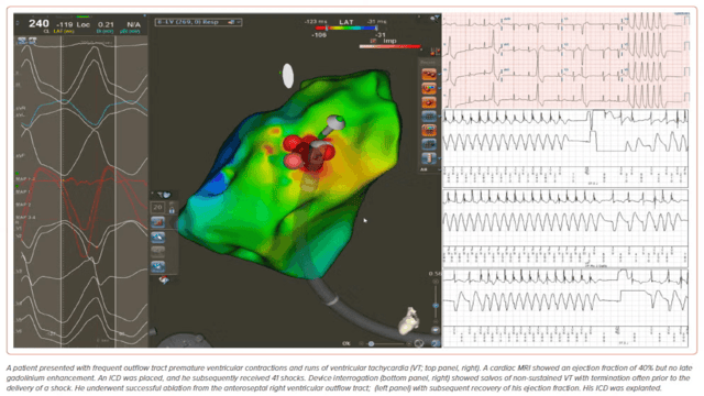 radcliffeCARDIO's tweet photo. 📚 New #AERJournal Article: "Management of Outflow Tract VAs"

📚 Just Published!

🔓Access it here 👉 https://t.co/RKsDHrqQbC

 #CVImaging #MedEd #Electrophysiology #Arrhythmia https://t.co/0DGtJaoOvp