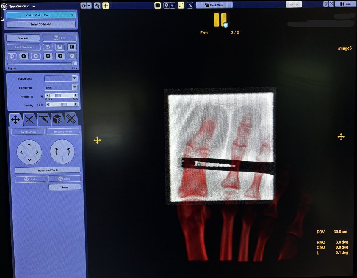 IR_Tech96's tweet photo. A successful case that highlights the synergy between advanced technology and clinical expertise.

A Bone RFA procedure was recently performed for a patient diagnosed with osteoid osteoma of the big toe at HMG – Al Takhassusi, led by Dr. Shagran Binkhamis @sbinkhamis , using the Allia IGS 730 Pulse system with 3DCT HD (CBCT) and Needle ASSIST.