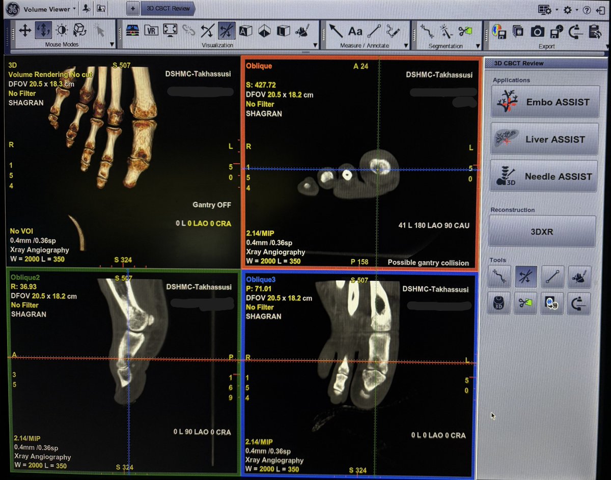 IR_Tech96's tweet photo. A successful case that highlights the synergy between advanced technology and clinical expertise.

A Bone RFA procedure was recently performed for a patient diagnosed with osteoid osteoma of the big toe at HMG – Al Takhassusi, led by Dr. Shagran Binkhamis @sbinkhamis , using the Allia IGS 730 Pulse system with 3DCT HD (CBCT) and Needle ASSIST.