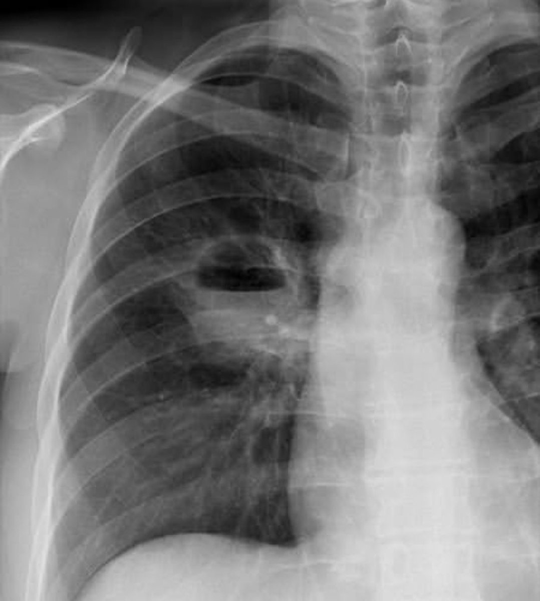 Sage_medics's tweet photo. CHEST X-RAY. 

Has a History of breast cancer, Describe the abnormality. 

What is the possible diagnosis? 

Annotations slide 2. https://t.co/PDazuFJylA