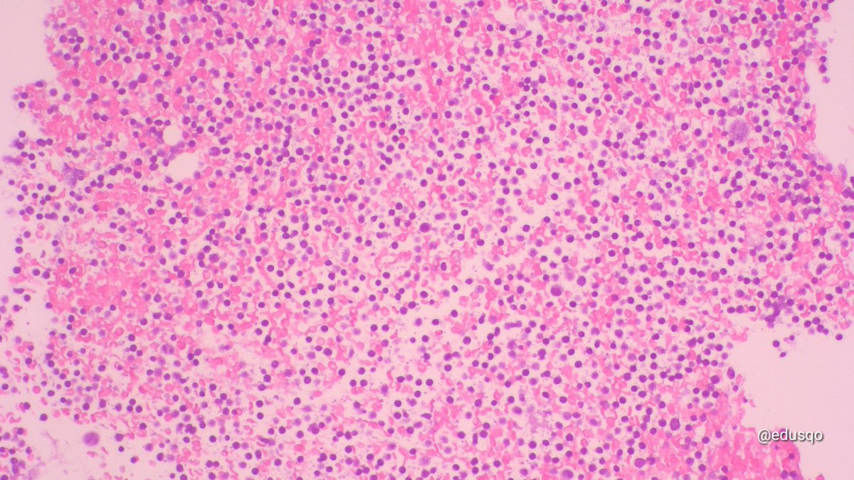 edusqo's tweet photo. ¿Se pueden tener mejores técnicos? Is it possible to have better technicians?
Tiny clot from a FNA. Paraffin embedding is crucial step in the tissue processing for a precise diagnosis. No AI, no robots. Humans, proffesionals.
#FNAFriday #CytoPath #CellBlock https://t.co/ndf5m1pYD4