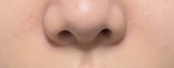 re_s2a's tweet photo. シンサエル整形外科さんで目の下脂肪再配置+脂肪注入、ほうれい線脂肪注入をして約3ヶ月が経過しました！
写真は1、2枚目が術前、3、4枚目が現在です。

先週、脂肪注入の無料リタッチに伺ってきました！
定着して少なくなっていた部分に脂肪を再度注入していただいたのでかなり良い状態です😺👍🏻 https://t.co/Ocr12QrhQb