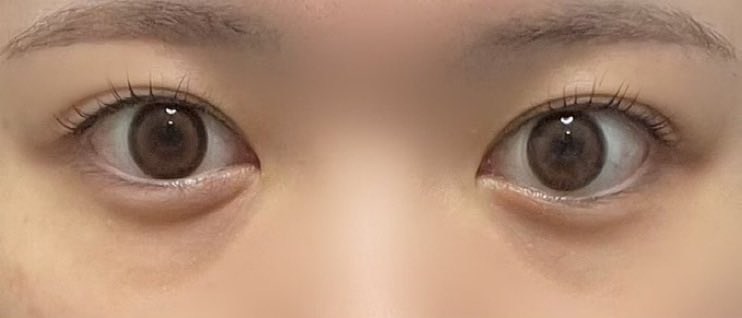 re_s2a's tweet photo. シンサエル整形外科さんで目の下脂肪再配置+脂肪注入、ほうれい線脂肪注入をして約3ヶ月が経過しました！
写真は1、2枚目が術前、3、4枚目が現在です。

先週、脂肪注入の無料リタッチに伺ってきました！
定着して少なくなっていた部分に脂肪を再度注入していただいたのでかなり良い状態です😺👍🏻 https://t.co/Ocr12QrhQb