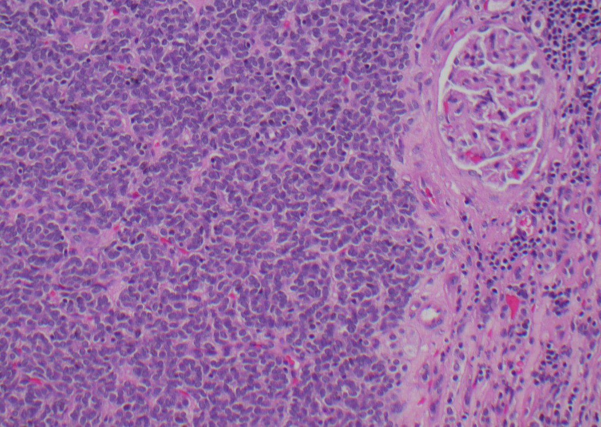 DrCycloPath's tweet photo. 55-year-old female with an incidental, well-circumscribed renal mass and polycythemia.
#PathQuiz 🔬🧬 #KidneyPath #GUPath
A) Nephroblastoma
B) Papillary Renal Cell Carcinoma
C) Mucinous Tubular and Spindle Cell Carcinoma
D) Metanephric Adenoma https://t.co/5DcV2eyzGu